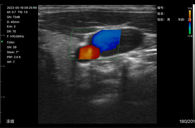 Doppler Color Vascular